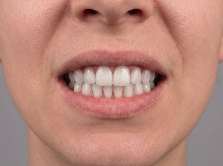 After treatment: whitened, even teeth