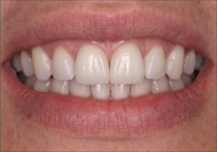 After treatment