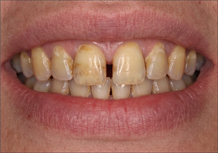 Before treatment