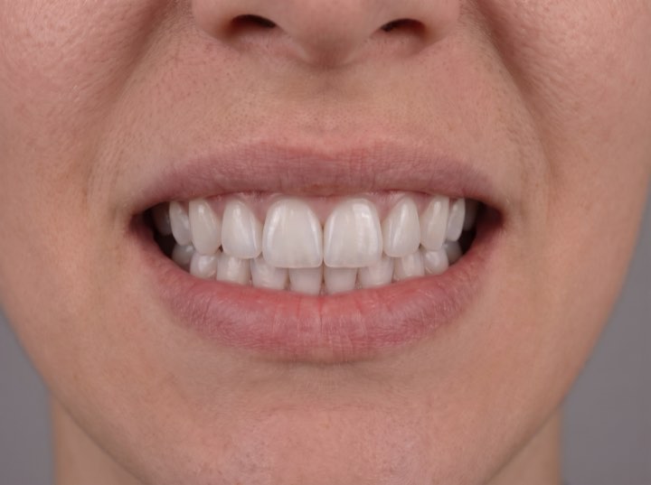 After treatment