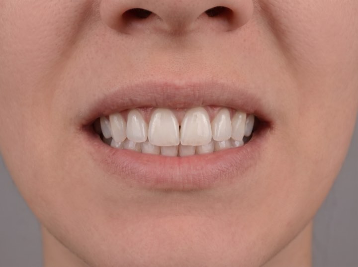 After treatment