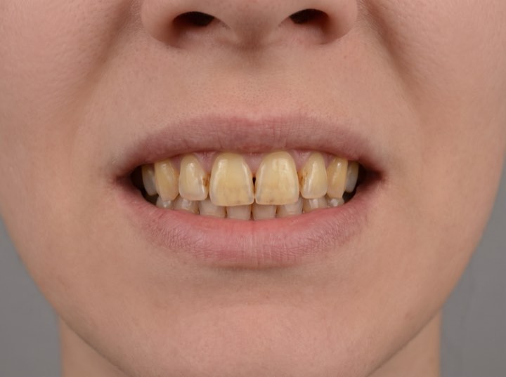 Before treatment