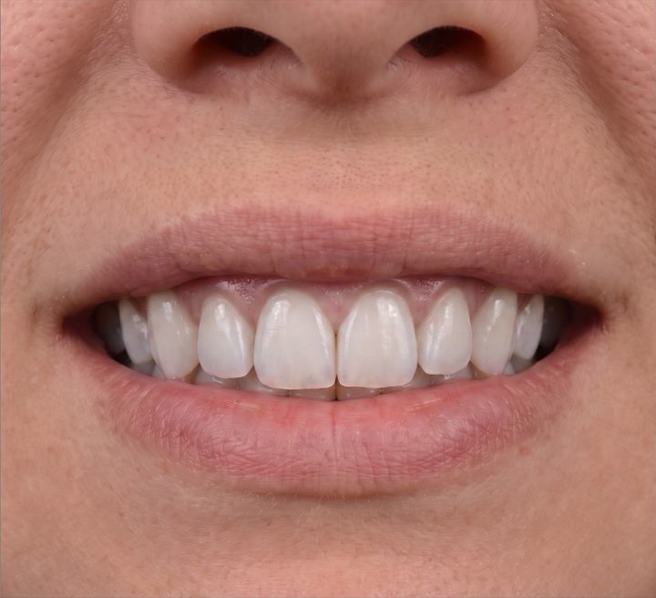 After treatment