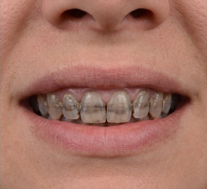 Before treatment